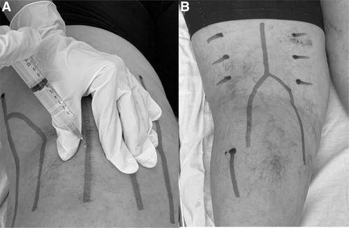 Perineural Injection Therapy (PIT)