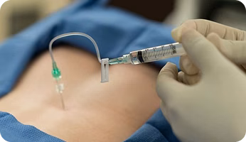 Steroid Injection