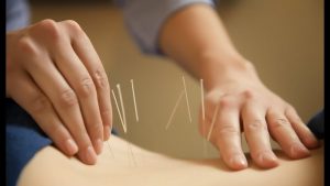 Acupuncture Therapy​