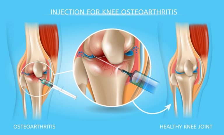 Knee injection therapy