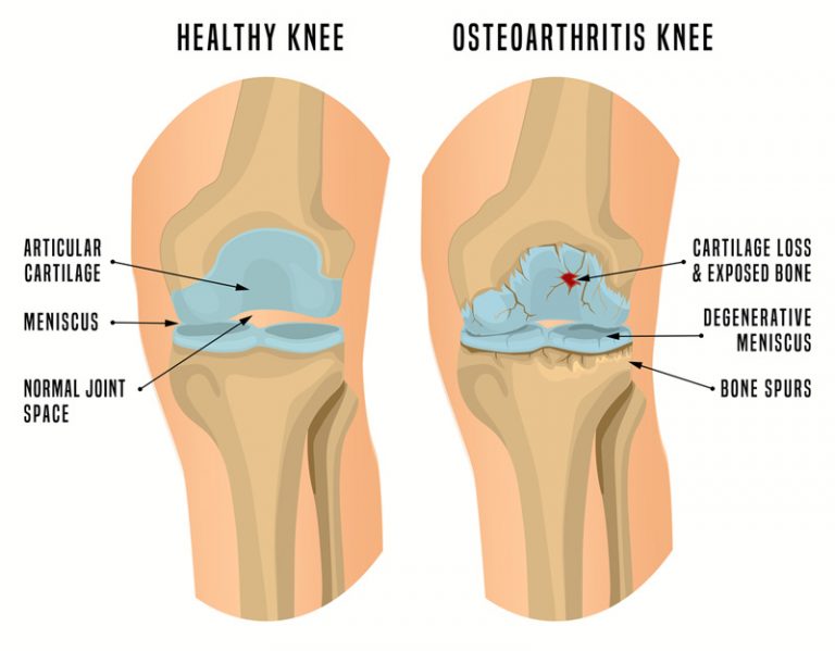 knee osteoarthritis